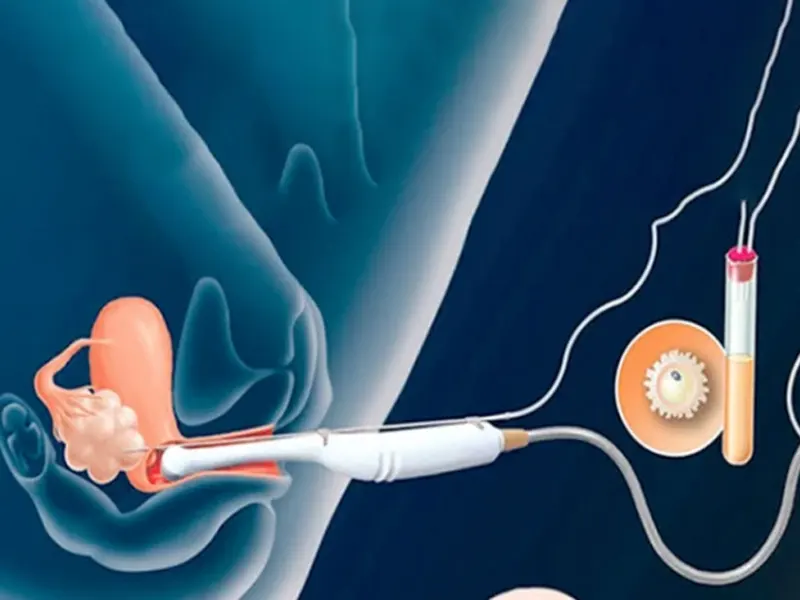 مراحل آی وی اف (IVF) چیست